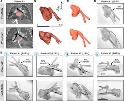 Patient-specific 3D in vitro modeling and fluid dynamic analysis of primary pulmonary vein stenosis